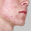 Clear Balance: Acne-Prone Skin Essentials