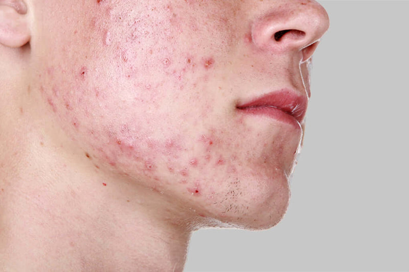 Clear Balance: Acne-Prone Skin Essentials