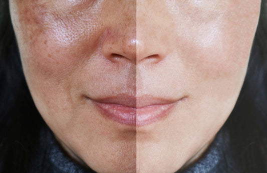 Radiance Restore: Redness & Dark Spot Solutions
